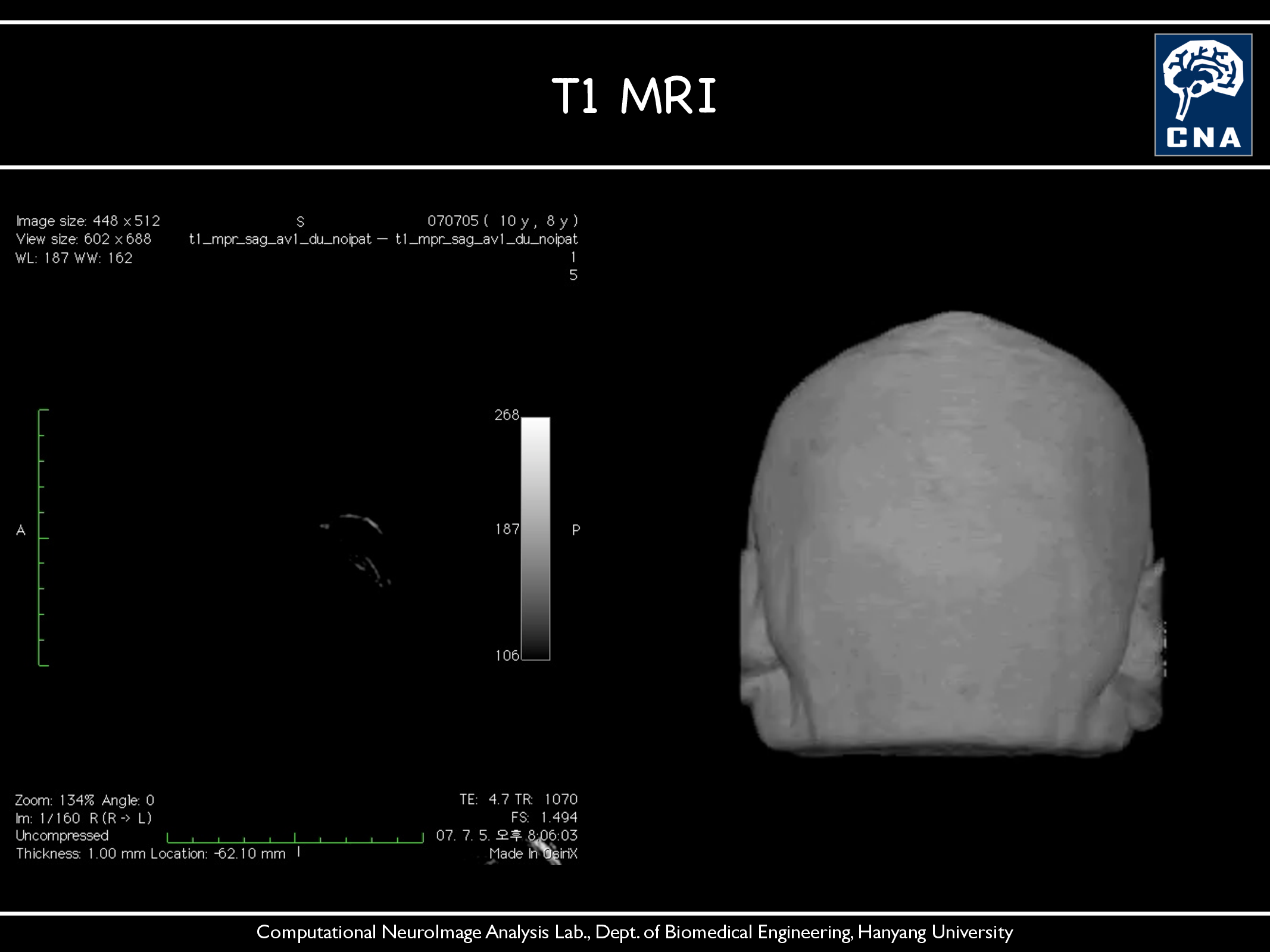T1 MRI
