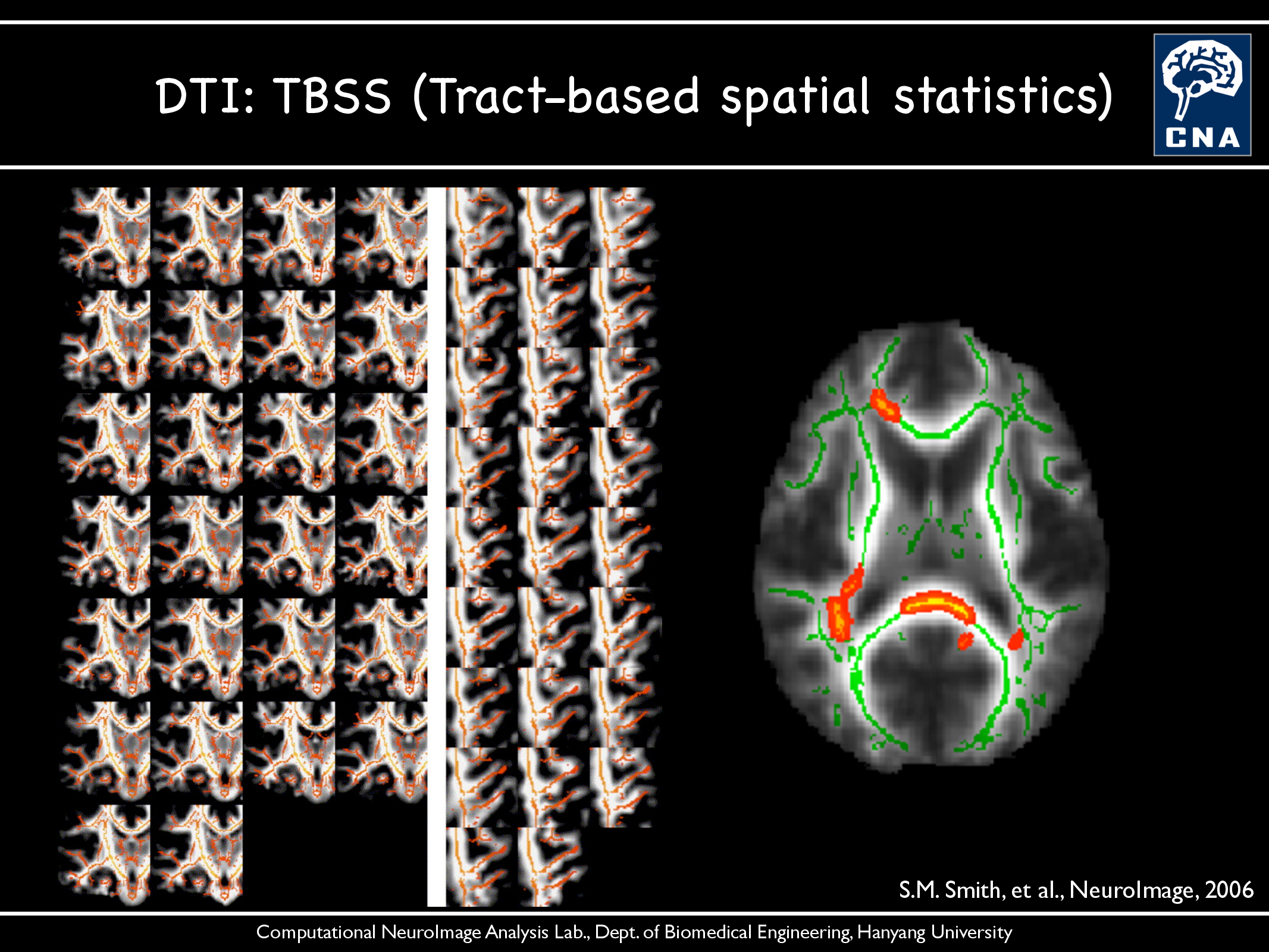 DTI-TBSS (Tract-based spatial statistics)